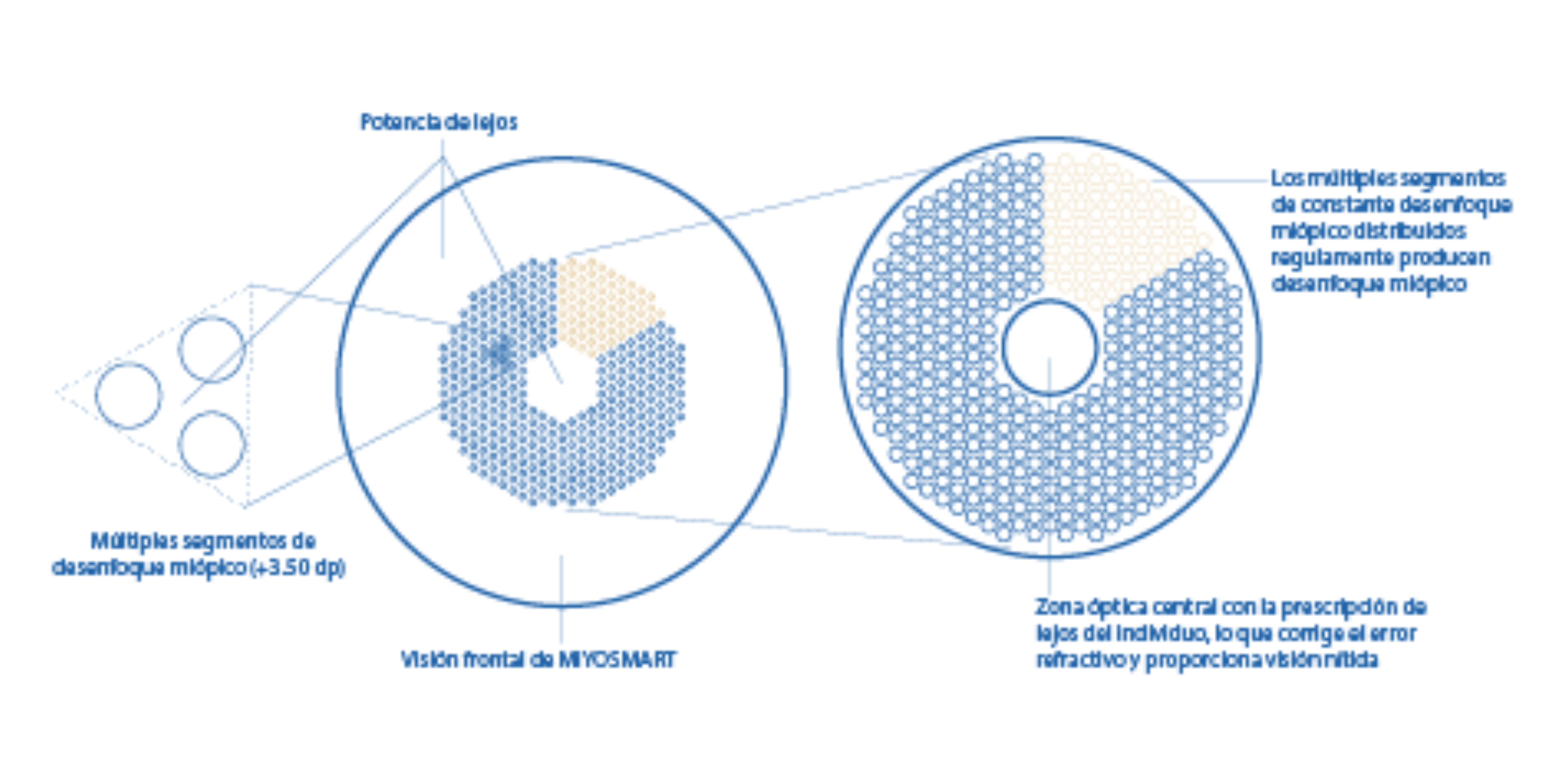Funcionamiento de las lentes de desenfoque miópico